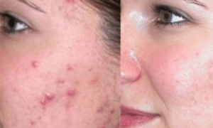 How-to-get-rid-of-pimple-marks