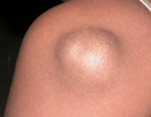 epidermal cyst picture
