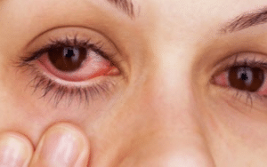 causes of red eyes