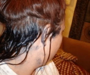 how to get rid of hair dye from skin