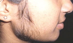 how-to-remove-face-hair-for-women-1