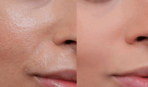 oily skin before and after