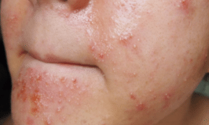 oily-skin-pimples-300x249-1