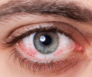 red veins in eye