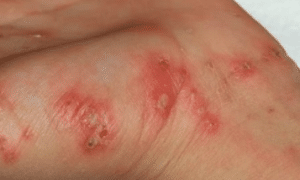 scabies-on-hands-300x225-1