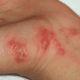 scabies-on-hands-300x225-1
