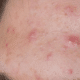 sebaceous-cyst-on-forehead-1