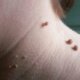 skin-tags-picture-1