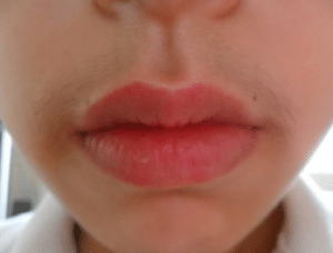 upper-lip-hair-300x228-1