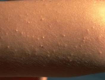 itchy bumps on skin causes