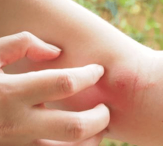 itchy bumps like mosquito bites