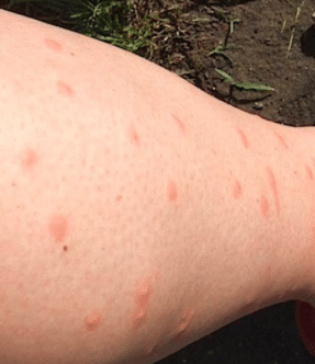 red bumps on legs