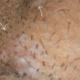 pimples-on-vag-300x243-1