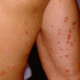 red-spots-on-skin-1