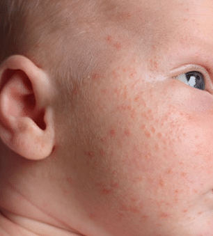 baby heat rash on face