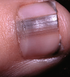 lines on nails