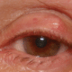bump-like-pimple-on-eyelid-1