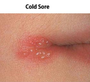cold sore on mouth
