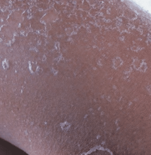 dry peeling skin on penis