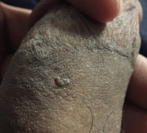 dry skin on penis