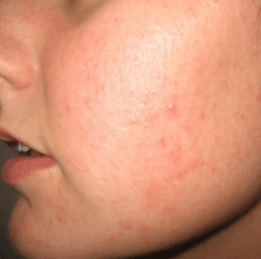 heat rash on face symptoms