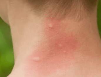how-to-get-rid-of-mosquito-bites-1