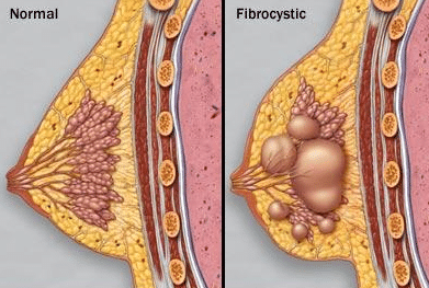 painful lump in breast fibrocystic