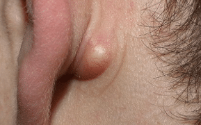 pea-sized-lump-behind-the-ear-1