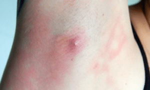 pimple-under-armpit-1