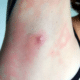 pimple-under-armpit-1