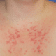 red-bumps-on-skin-1