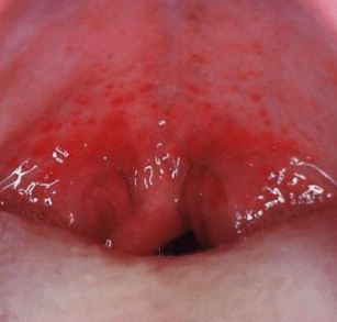 red spots on roof of mouth