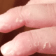 skin-peeling-on-fingers-picture-1