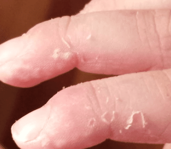 skin-peeling-on-fingers-picture-1