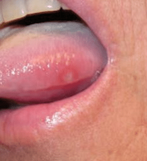 sore on side of tongue