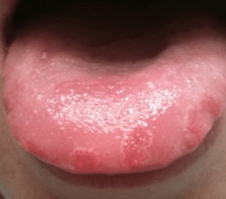 sore on tip of tongue