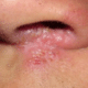 sores-in-nose-picture-1