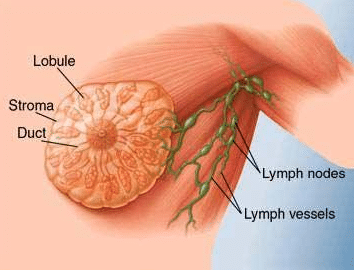 what is the painful lump in breast