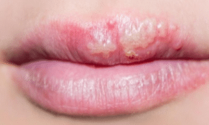 white-bumps-on-lips-1
