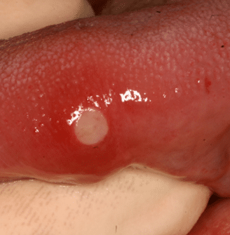 sore on side of tongue