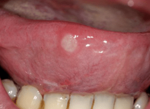 Cold-sore-on-tongue-causes
