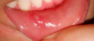 Sore inside Mouth Causes