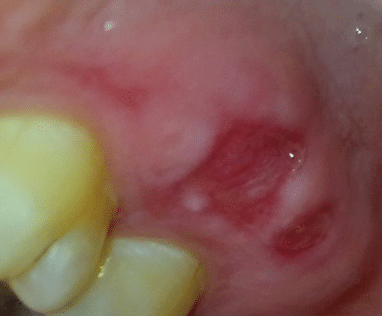 blisters on gums
