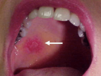 blisters on roof of mouth 