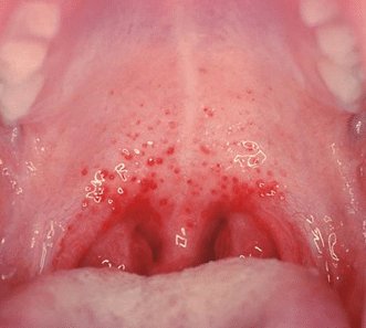 burn on roof of mouth
