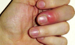 infected-finger-symtoms-1