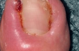 infected-ingrown-toenail-1
