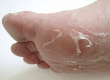 peeling-skin-on-feet-1