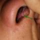 scabs-in-nose-picture-1