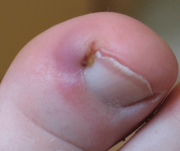 infected ingrown toenail symptoms